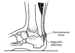 Abbildung 2: Das Haglund-Syndrom bezieht sich auf einen hervorstehenden Knochen an der oberen Ferse. Eine Bursitis subachillea bildet sich oft zwischen dem Haglund-Syndrom und der Achillessehne.