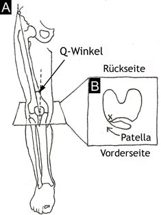 Abb. 1A: Der Q-Winkel oder Quadrizeps-Winkel, ist der Winkel, der zwischen dem oberen Becken, der zentralen Kniescheibe und dem Ansatzpunkt der Patellasehne am Schienbein gebildet wird. Da angenommen wird, dass ein großer Winkel Knieschmerzen verursacht, verändern Chirurgen gelegentlich diesen Winkel, indem sie seinen Ansatzpunkt verschieben. Abb. 1B: Eine lateral verschobene Patella neigt sich nach außen und ist einem größeren Druck ausgesetzt, da die Patella die laterale femorale Kondyle berührt (X).